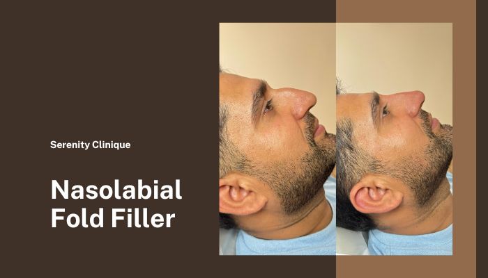 Nasolabial Fold Filler